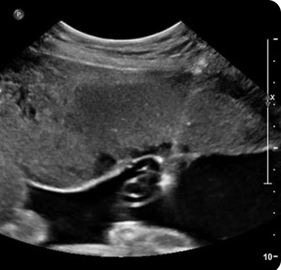 Amniotic Patch