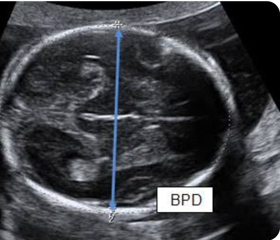 Growth / Doppler
