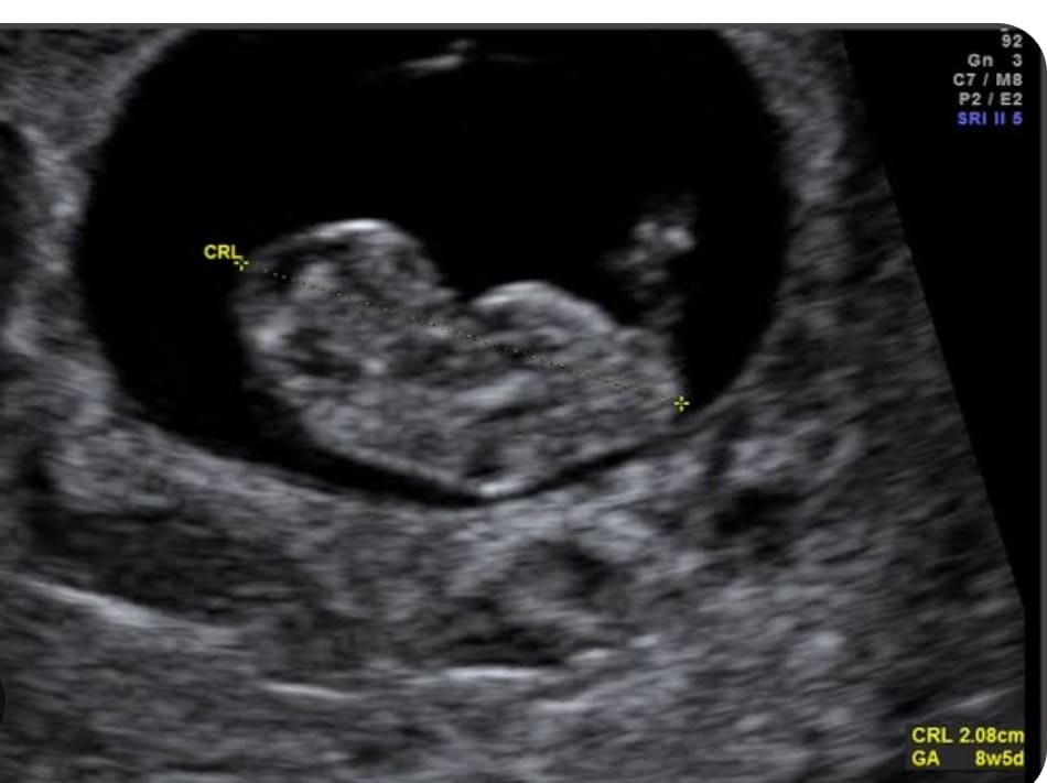 Early Pregnancy Scan