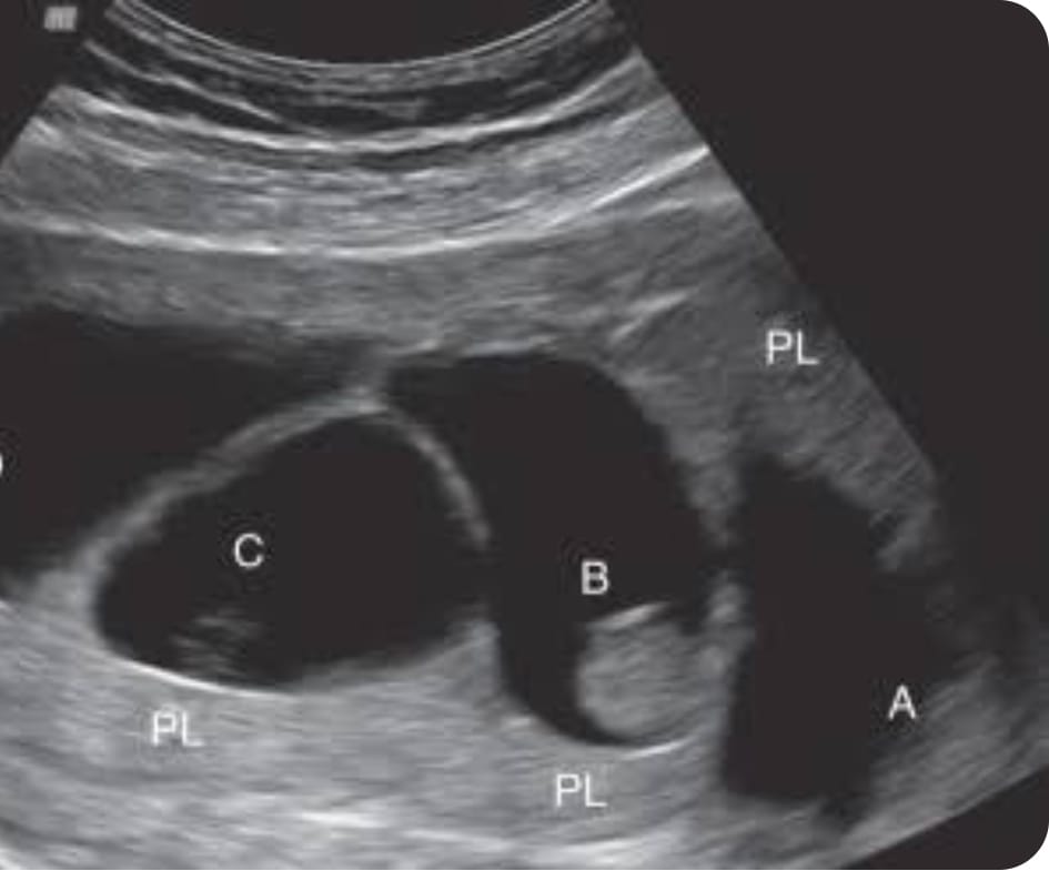 Fetal Reduction