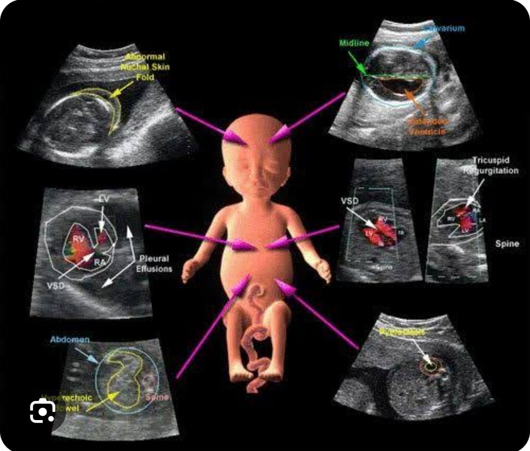 Genetic Sonography